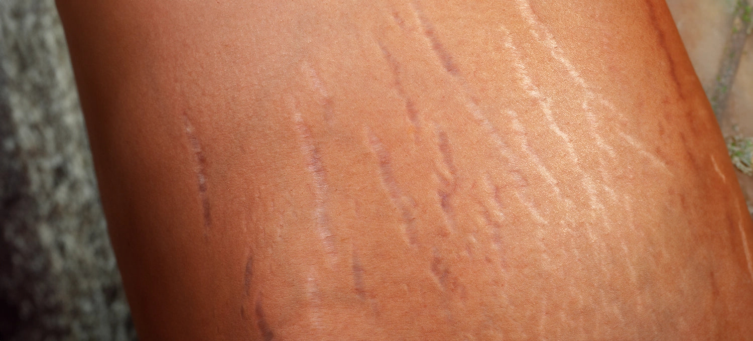 Is Argan Oil Effective for Stretch Marks? Here is How to Use It